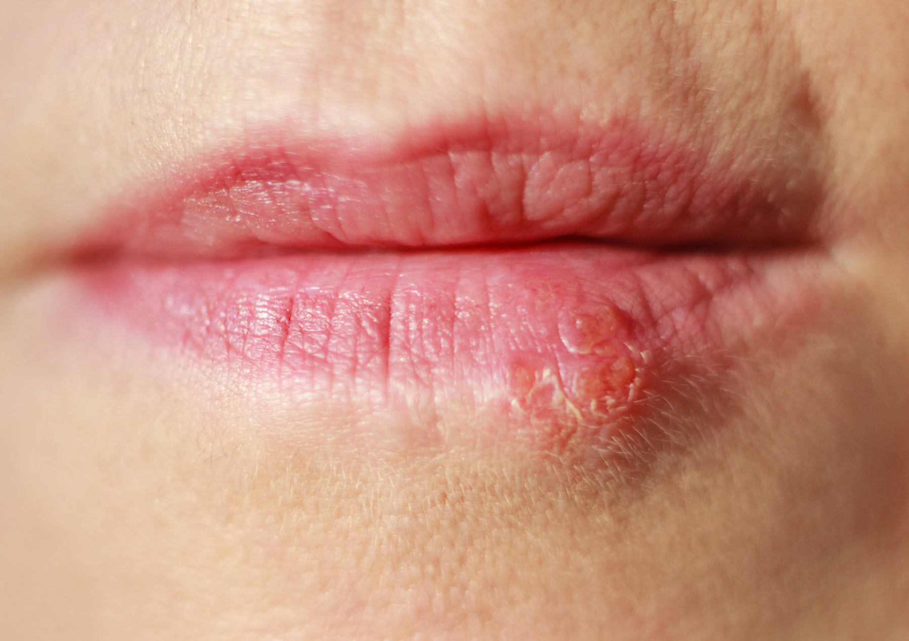 How To Help Prevent Cold Sores?