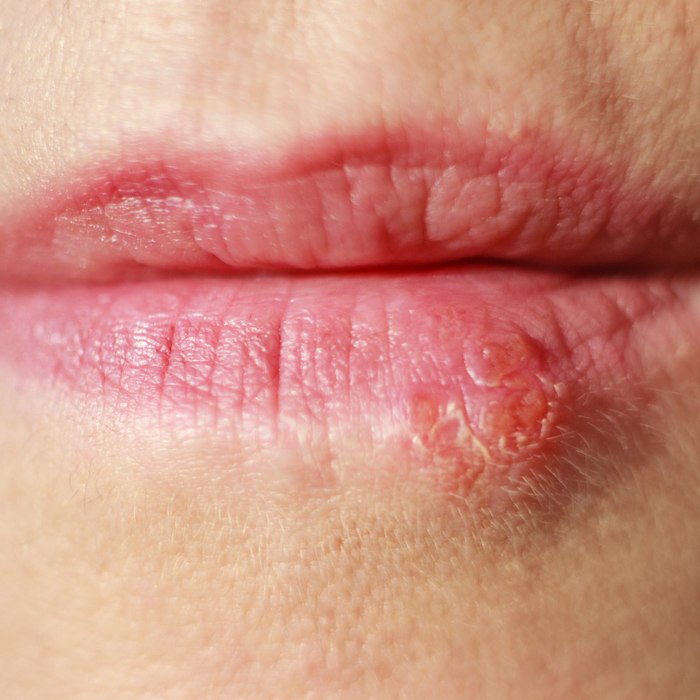 How To Help Prevent Cold Sores?